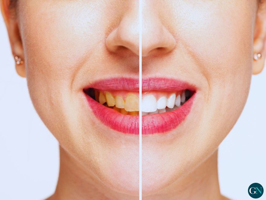 Blanqueamiento dental en Granollers 